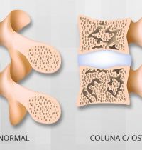 Osteoporose na Coluna