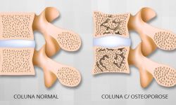 Osteoporose na Coluna