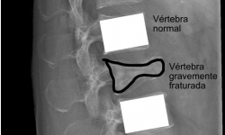 Fraturas na coluna