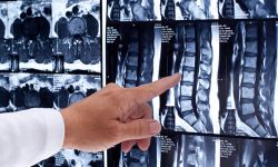 Cirurgias Minimamente Invasivas na Coluna Vertebral