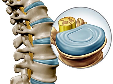 discos intervertebrais