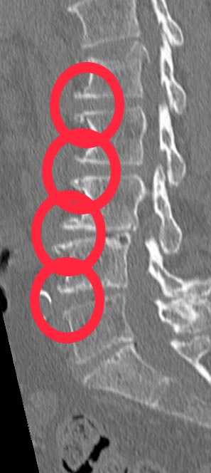 osteofitose 01