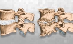 Doença Degenerativa do Disco